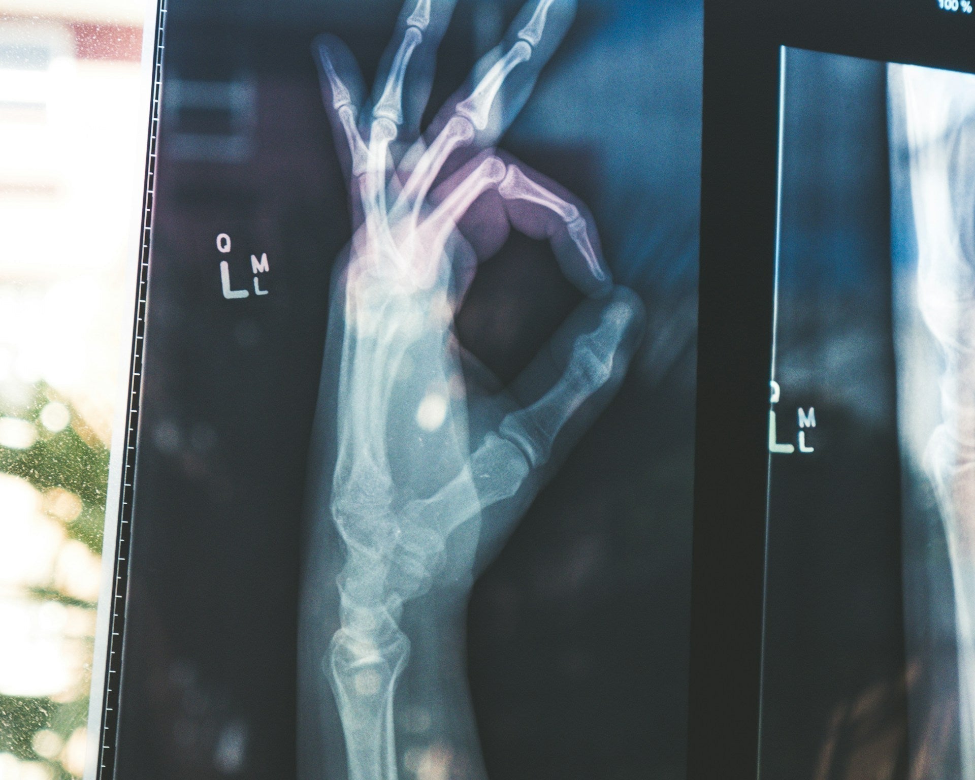 Bone Density and Midlife: Strengthening Your Skeleton Through Diet and Exercise