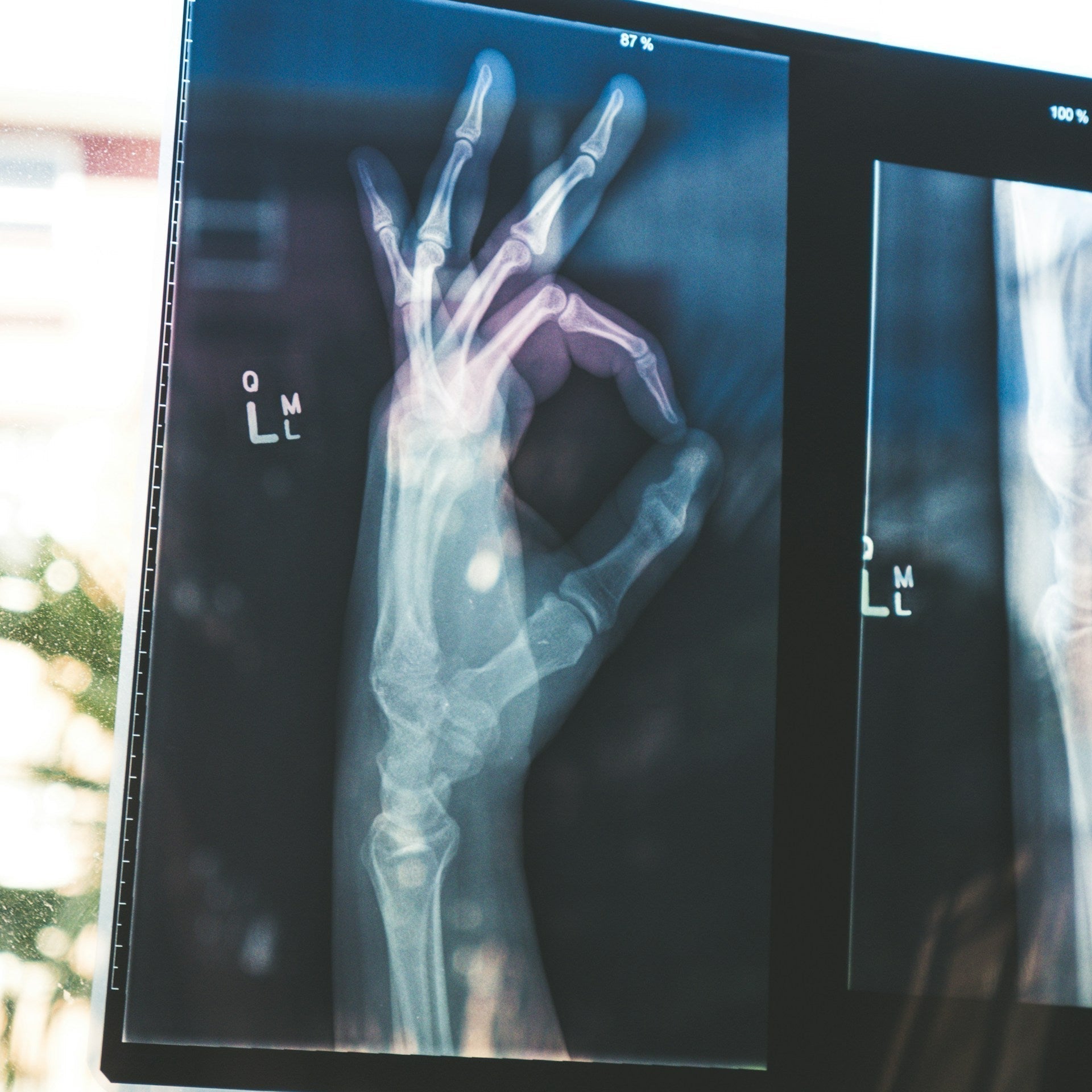 Bone Density and Midlife: Strengthening Your Skeleton Through Diet and Exercise